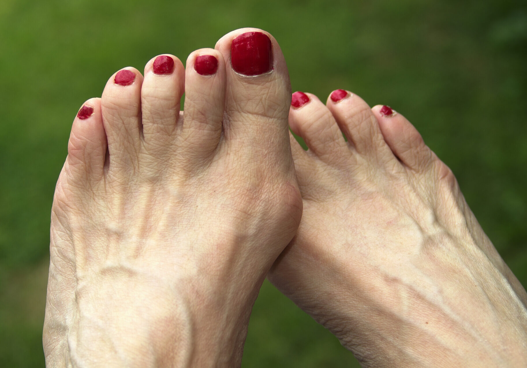 Bunion of foot of woman.