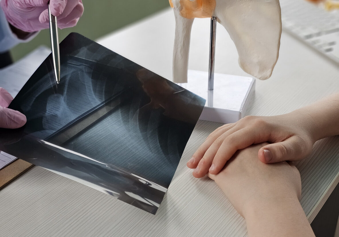 Doctor of skeletal shoulder joint and muscles and x-ray. Shoulder pain in patient and treatment